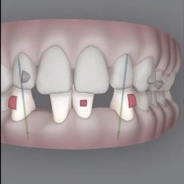 Invisalign® technology showing how to fix a complex tooth case