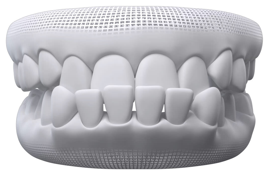 Underbite