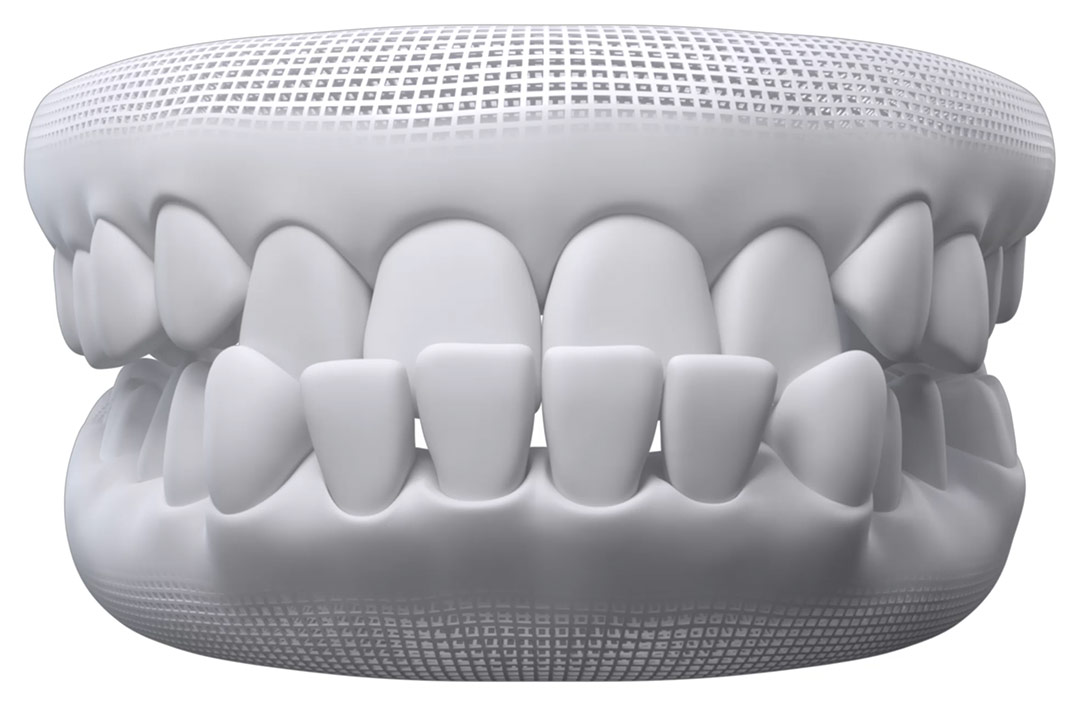 Jefferson Dental  Process of putting on Invisalign attachments