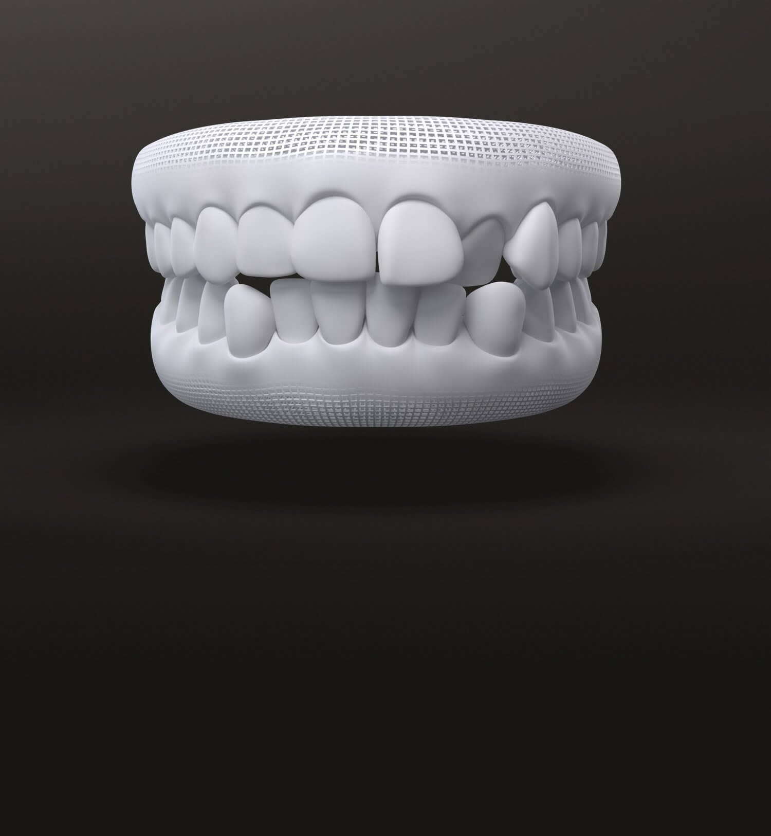 Denti disallineati modello 3D: prima del trattamento Invisalign - Italia
