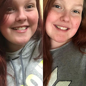 Little girl testimonial before and after treatment with Invisalign® clear aligners