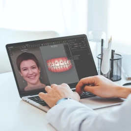 Clincheck® software showing a woman and her tooth movement with Invisalign treatment