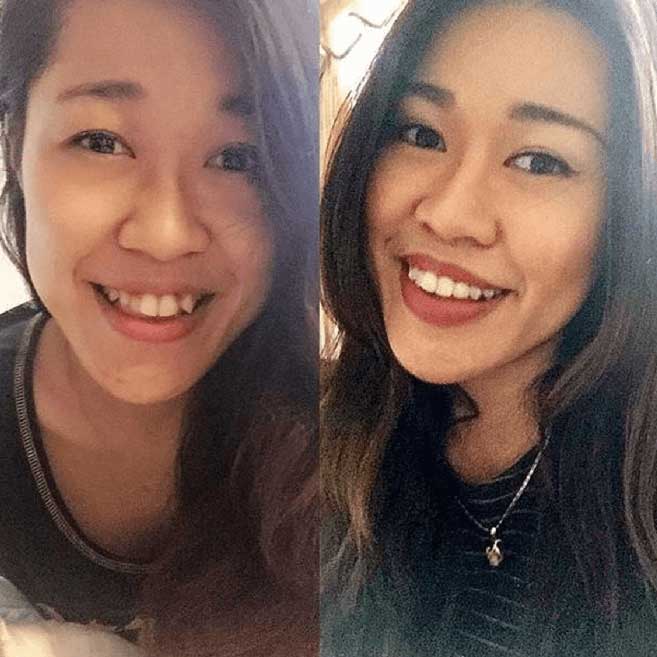 Before and after image of Invisalign Treatment