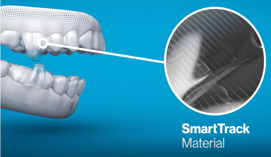 Sample of Invisalign aligners with enhanced precision wings