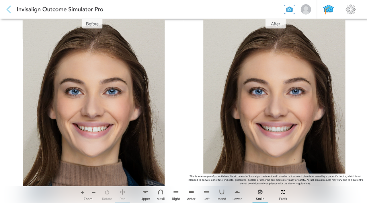 Invisalign Simulator Pro