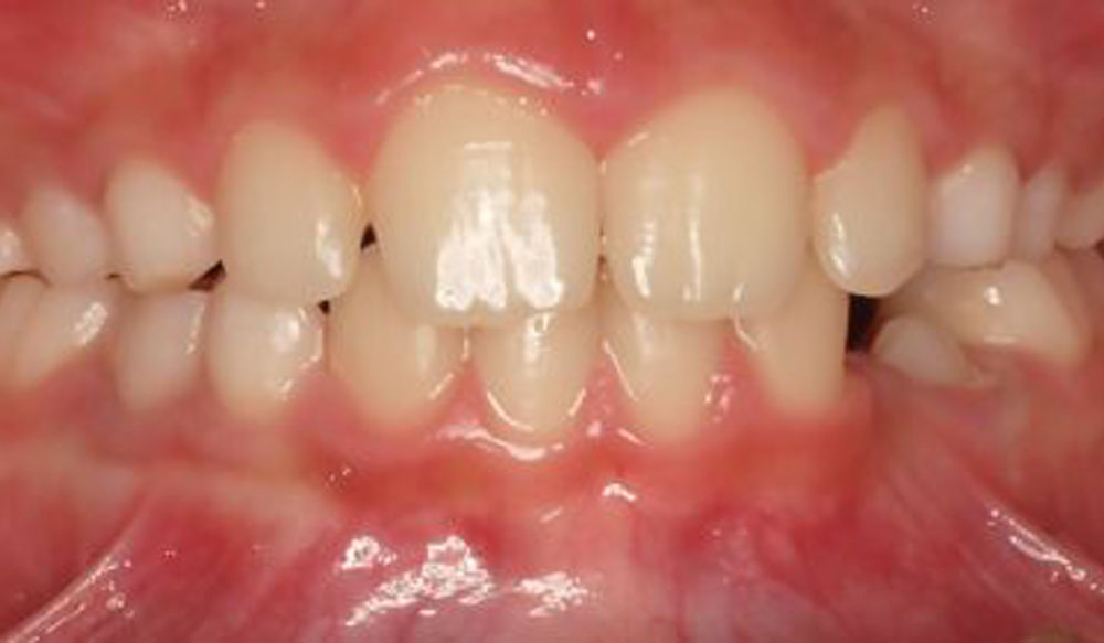 Invisalign Treatable Cases