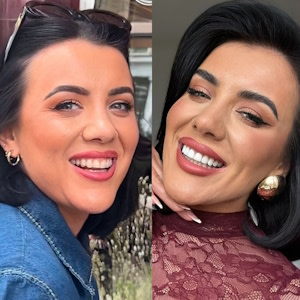 صورة امرأة قبل وبعد العلاج بتقويم Invisalign® الشفاف
