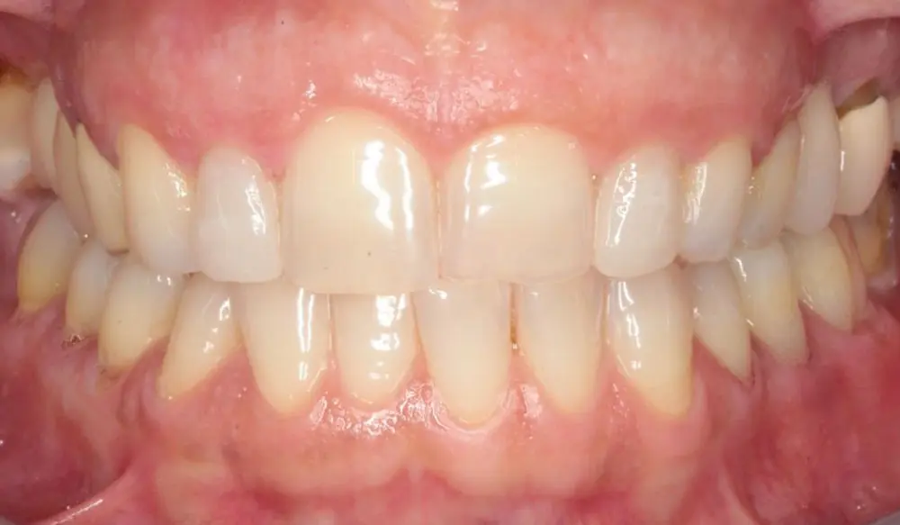 before image