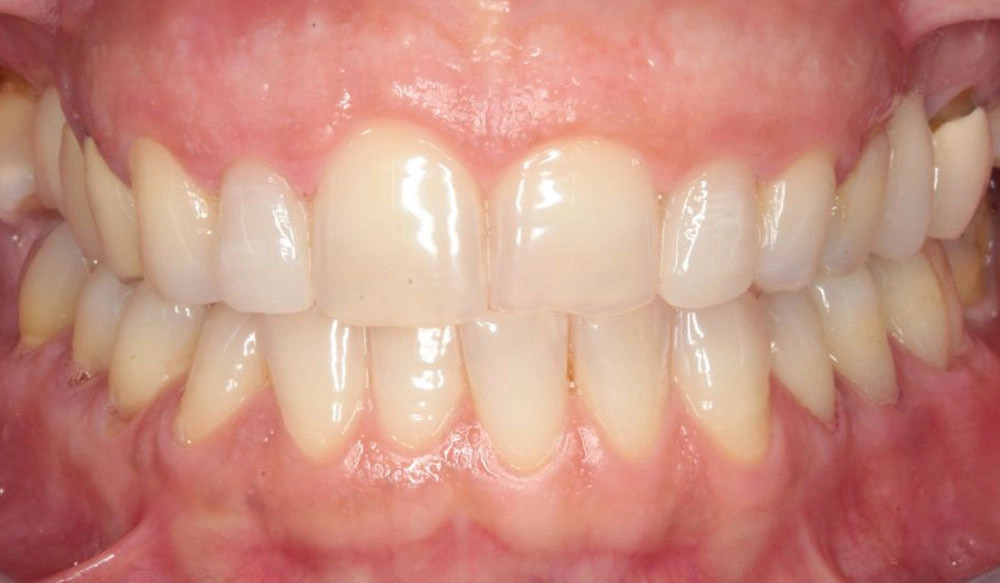 Generally straighter teeth case before Invisalign® treatment