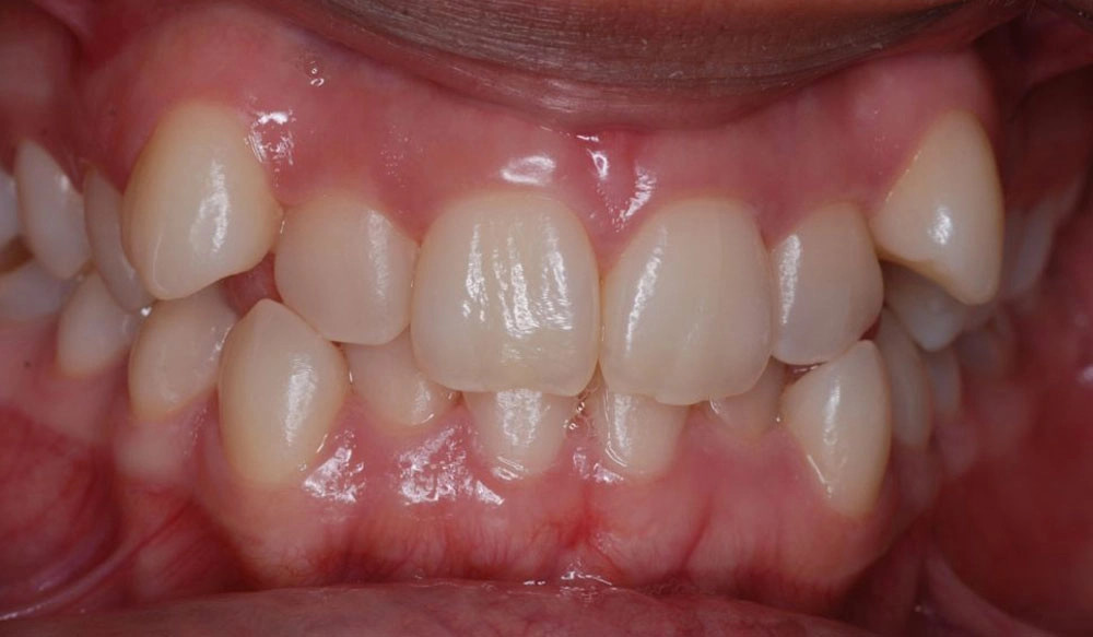 Narrow arches tooth case before Invisalign® treatment