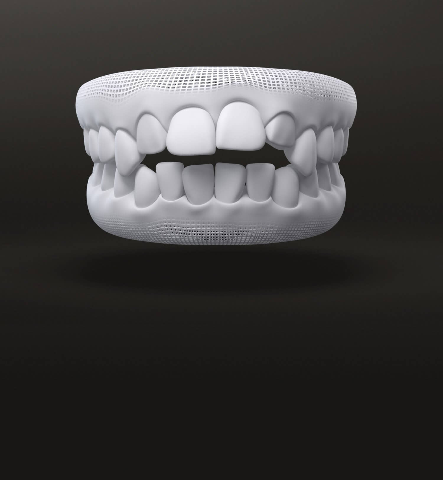Morso aperto modello 3D: casi trattabili con allineatori dentali Invisalign Italia