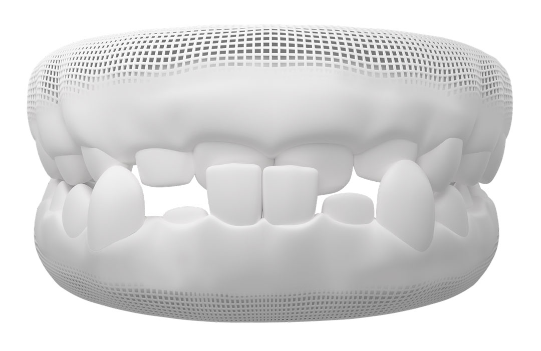 Is Invisalign Better Than Braces For Sensitive Teeth? - Tendercare