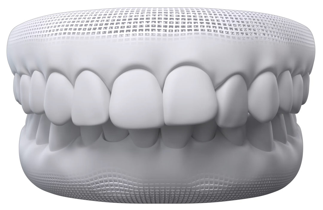 Overbite Teeth Photos