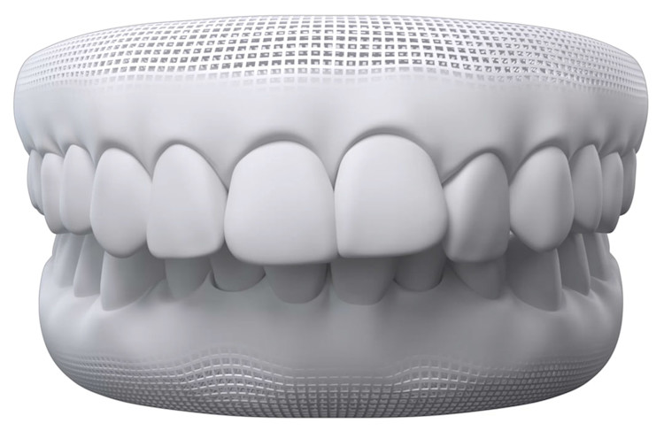 Overbite: what it is & how it affects smile | Invisalign
