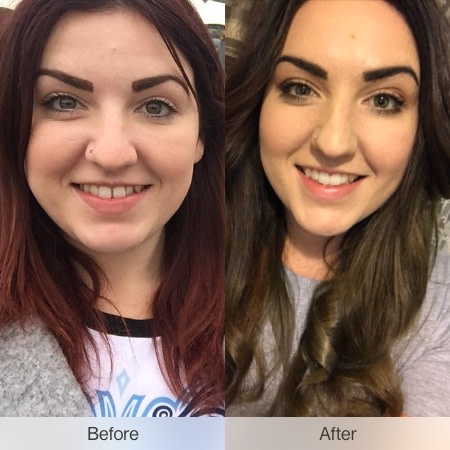 Before and after: discover Invisalign treatments