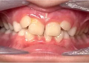 IPE Case 2 pre palatal expander