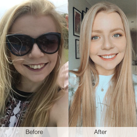 Before and after Invisalign treatment - Europe