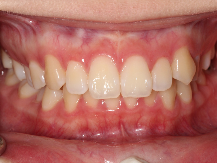 before image