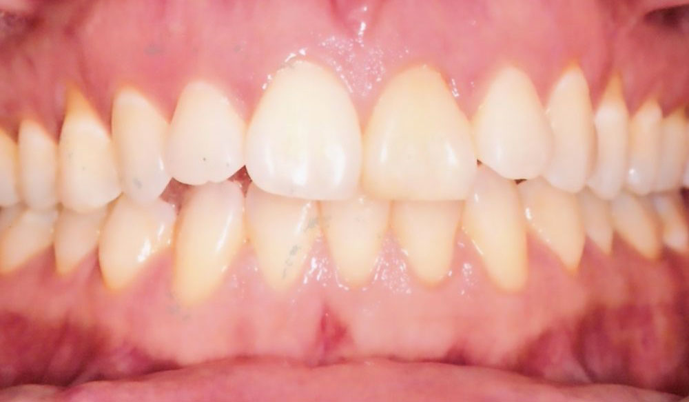 Dr Glaser's 10 Commandments of Invisalign Treatment Design Revisited