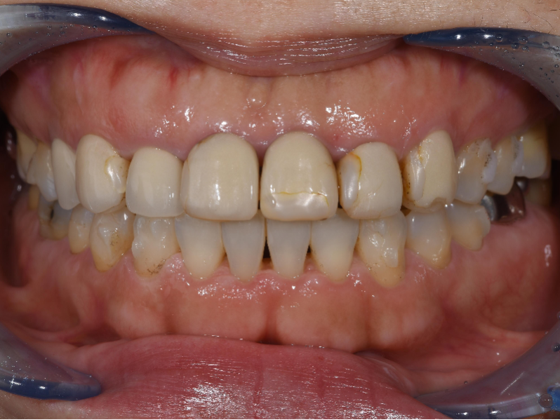 before image