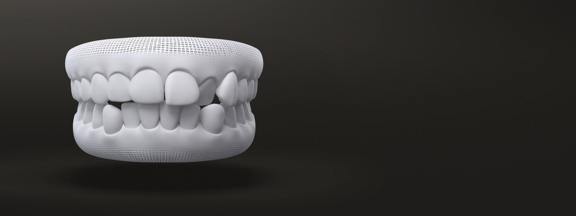 Denti disallineati modello 3D: casi trattabili con allineatori dentali Invisalign - Italia