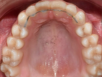 Narrow arches tooth case after Invisalign® treatment