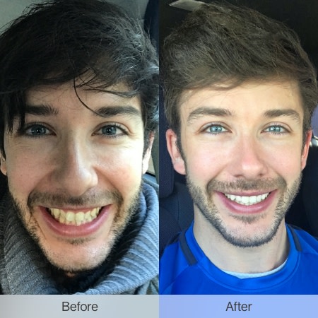 Before and after the Invisalign treatment