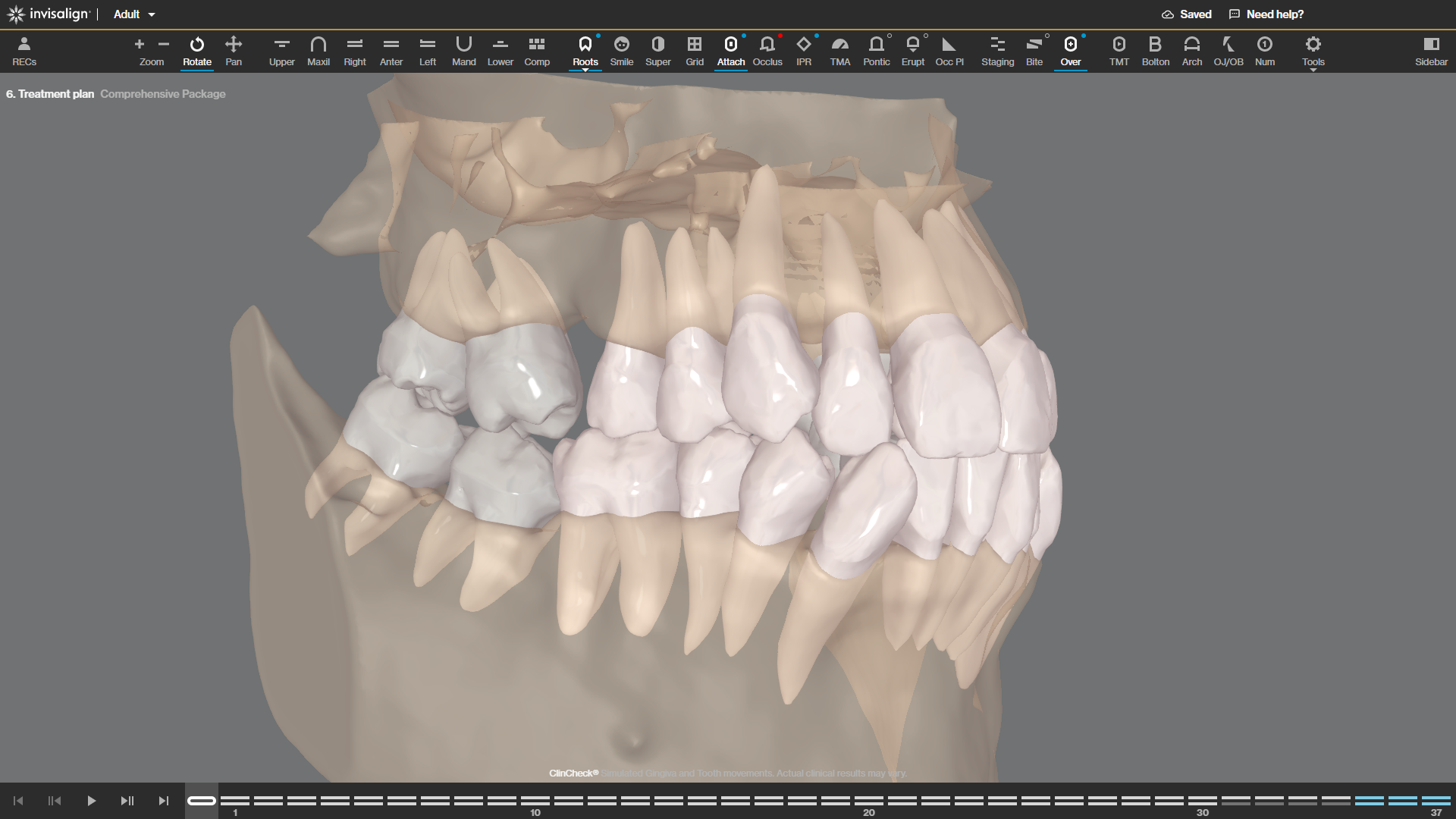 2-Crowns and roots w-semitransparent bone