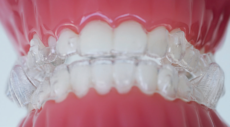 Come funziona il trattamento Invisalign? Esempio di allineatori dentali - Italia