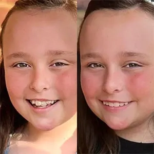 Little girl testimonial before and after treatment with Invisalign® clear aligners
