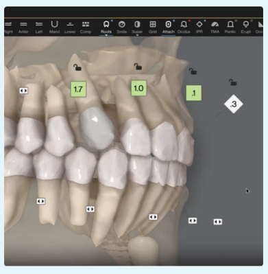 See patients’ roots, crowns and bone in an auto-generated 3D model within ClinCheck. Bone visualisations based on actual scan data to provide doctors with details otherwise left unseen.