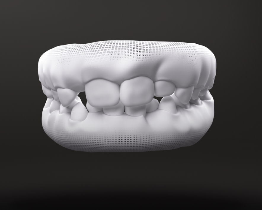 Invisalign First > AlignerImgNw