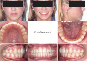 case report girl teeth