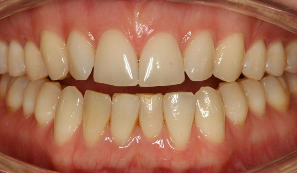 Open bite tooth case before Invisalign® treatment