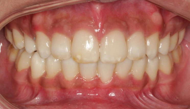 Deep bite tooth case after Invisalign® treatment