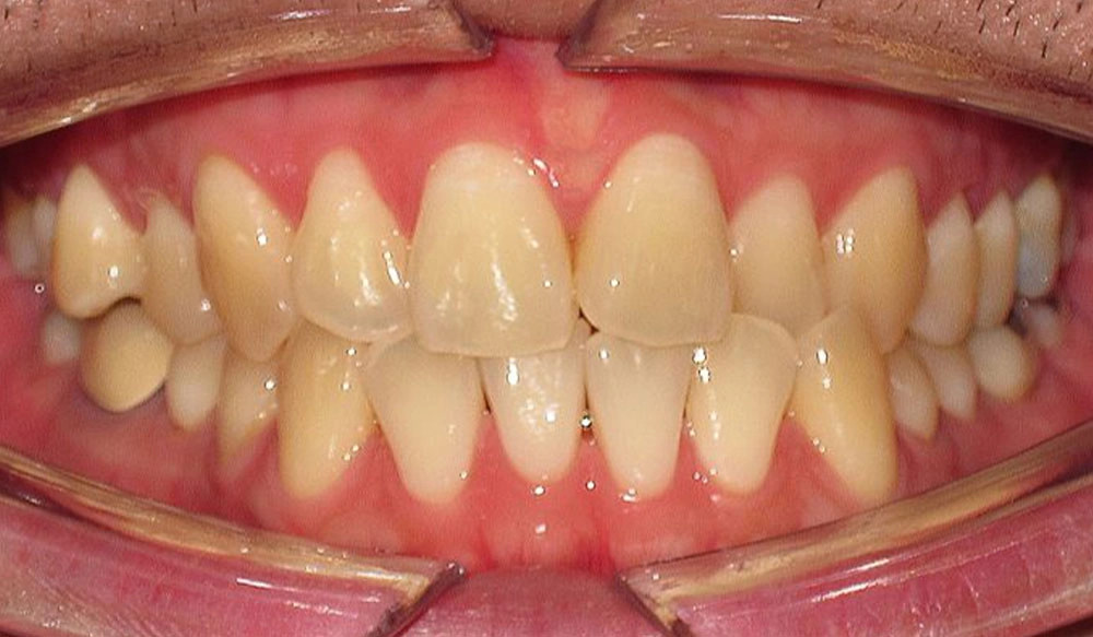 Anterior crossbite tooth case before Invisalign® treatment