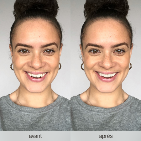 Before and after an Invisalign treatment: how your smile will change