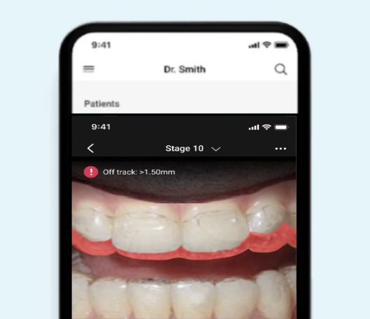Invisalign Virtual Care AI view on an iPhone