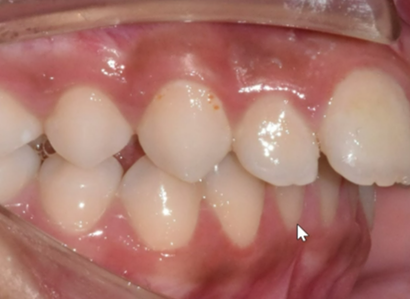 Mandibular advancement case before Invisalign® treatment
