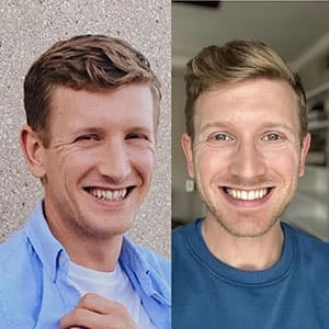 Young man testimonial before and after treatment with transparent aligners