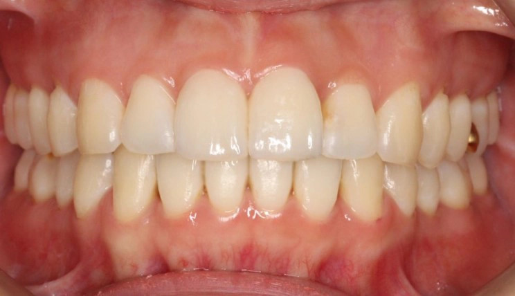 Midline discrepancy tooth case after Invisalign® treatment