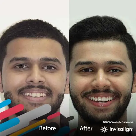 Why Invisalign?