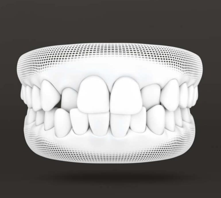 Treatable Cases > Carousel > Crossbite > Image