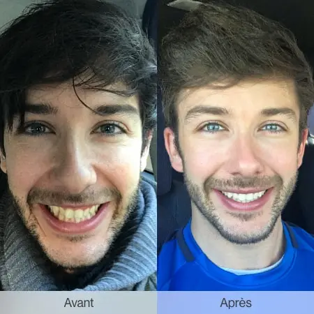 Before and after an Invisalign treatment: how your smile will change