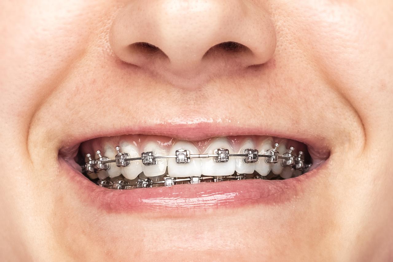 Someone smiling with braces
