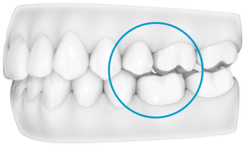 Invisalign's dome-shaped G5 attachments on the premolars and G7