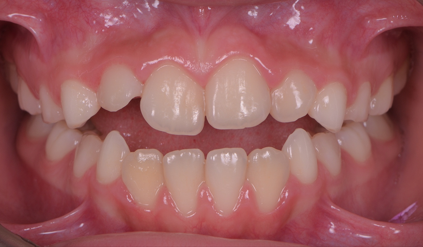 before image
