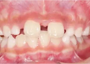 IPE > Case study 1 > Post Invisalign Palatal Expander