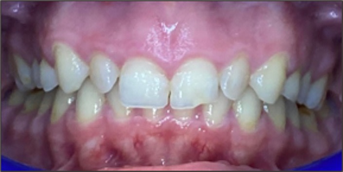 Clinical case studies using Invisalign® clear aligner therapy