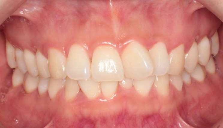 Midline discrepancy tooth case before Invisalign® treatment